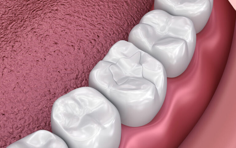 What to Expect After Your Composite Tooth Filling
