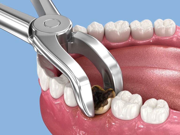 Same-Day Tooth Extraction: What El Paso Patients Should Know